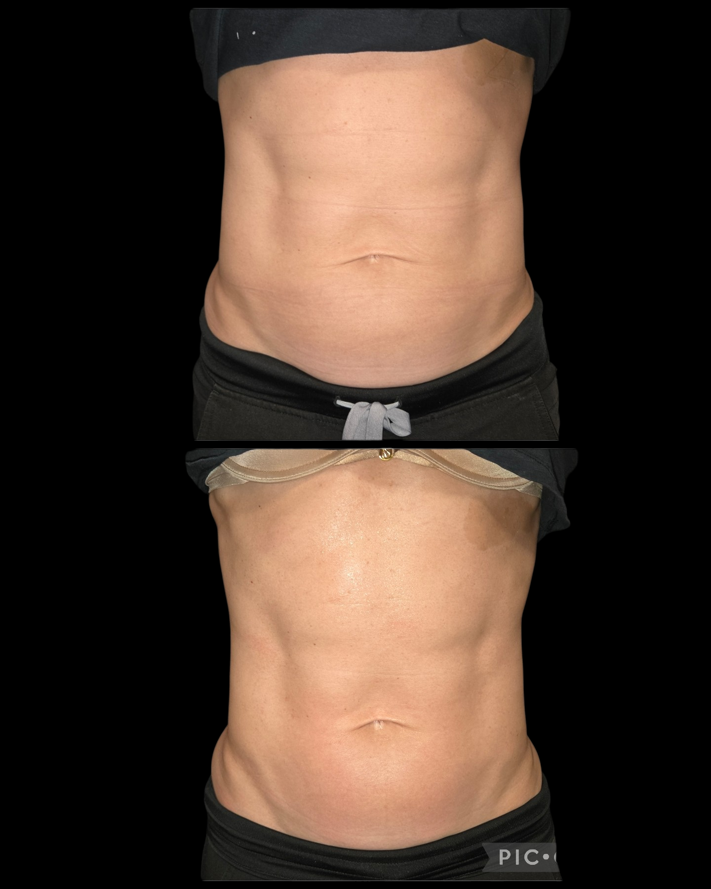 Emsculpt NEO Results 1